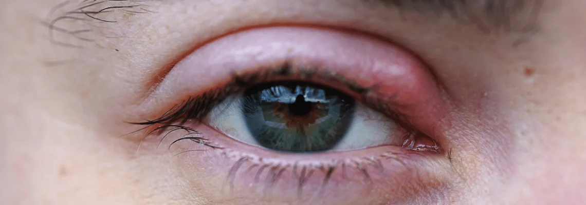 Czym jest i jak się leczy jęczmień na oku?