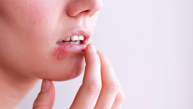 Jak szybko wyleczyć opryszczkę na ustach? Sprawdzone metody