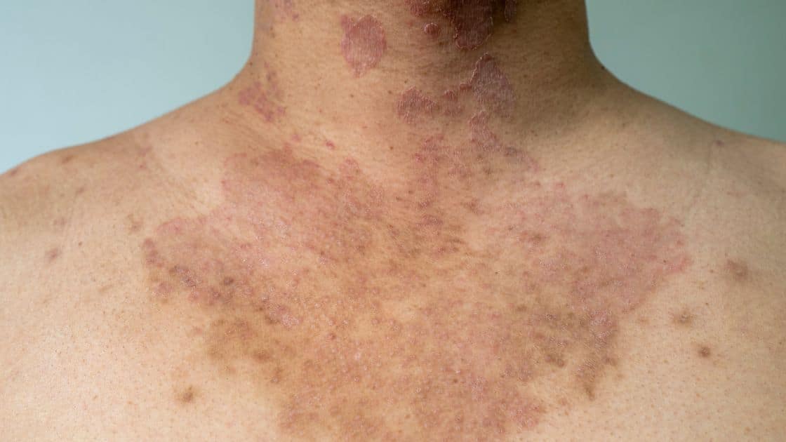 Grzybica Objawy Leczenie Przyczyny EDoktorzy pl Grzybica Objawy Leczenie Przyczyny EDoktorzy pl