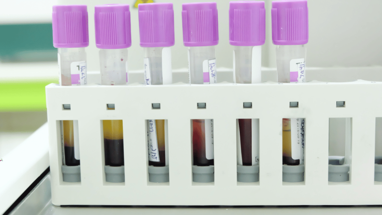 Sześć probówek z fioletowymi nakrętkami, zawierających próbki krwi, umieszczonych w białym stojaku laboratoryjnym. Probówki są częściowo wypełnione krwią oraz osoczem, gotowe do analizy hematologicznej.