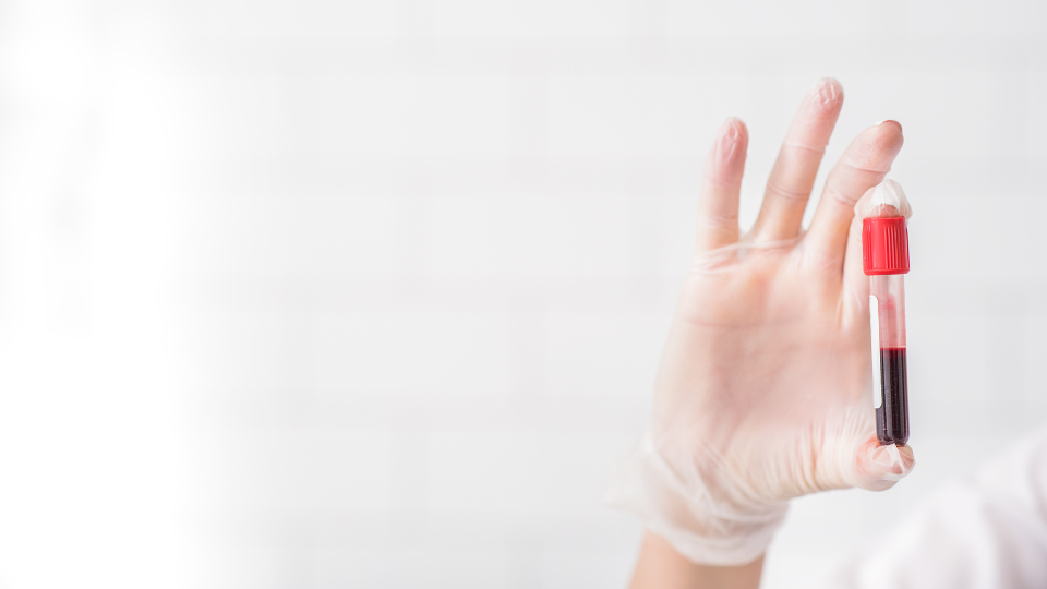 Co to jest RDW-SD? Norma, interpretacja wyników i kiedy może niepokoić?